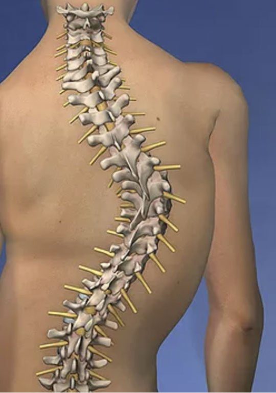 脊柱側弯症を理解する