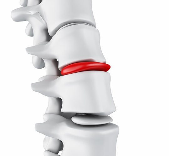 脊柱側弯症は、治療が非常に難しい脊椎疾患です。