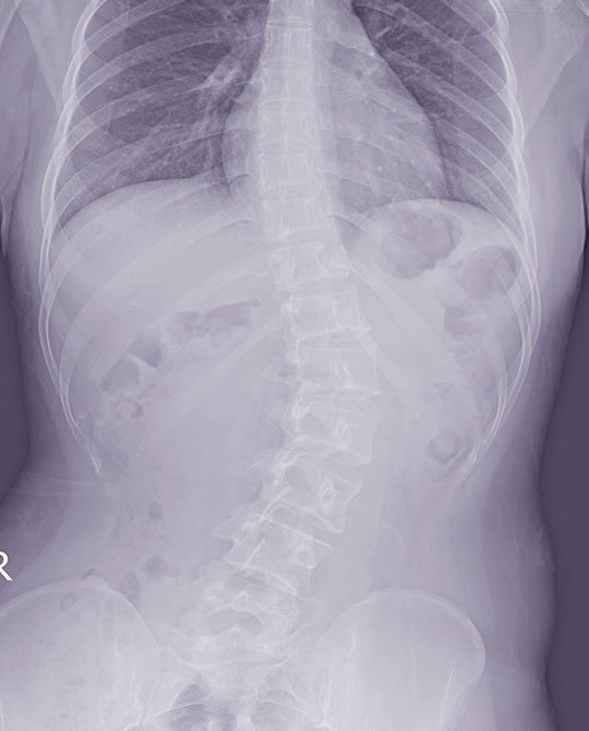 3種類の特発性脊柱側弯症